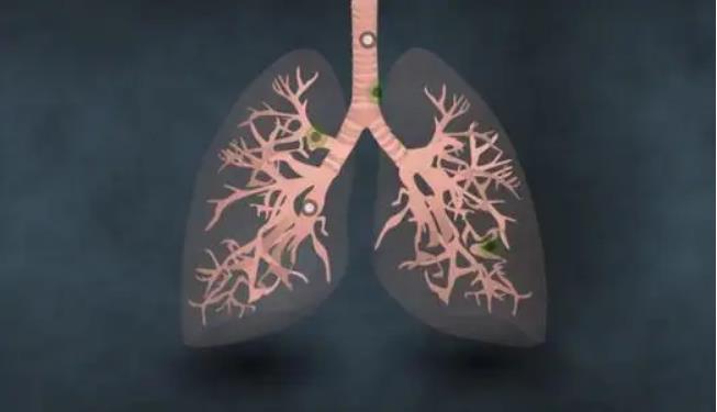廣東專家找到肺癌復發預測利器