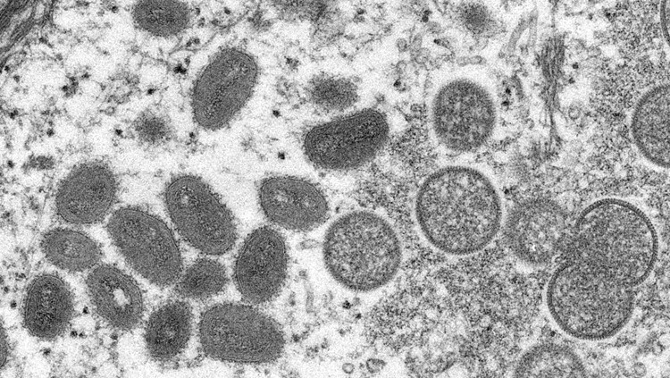 西班牙猴痘確診病例超5000例